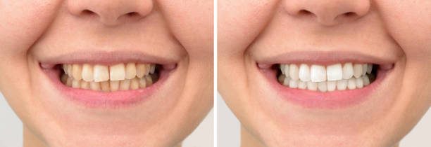 Teeth Whitening Before and After