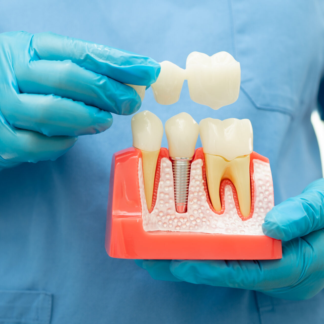 Dental implant, artificial tooth roots into jaw, root canal of dental treatment, gum disease, teeth model for dentist studying about dentistry.