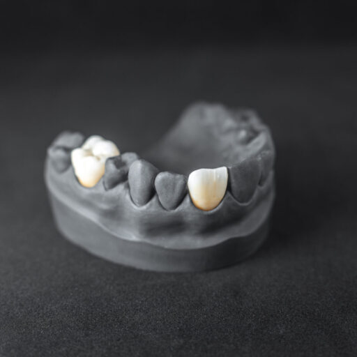 Close-up on plaster model of painted in black artificial jaw with implant crown on the black background. Concept of aesthetic dentistry and implantation