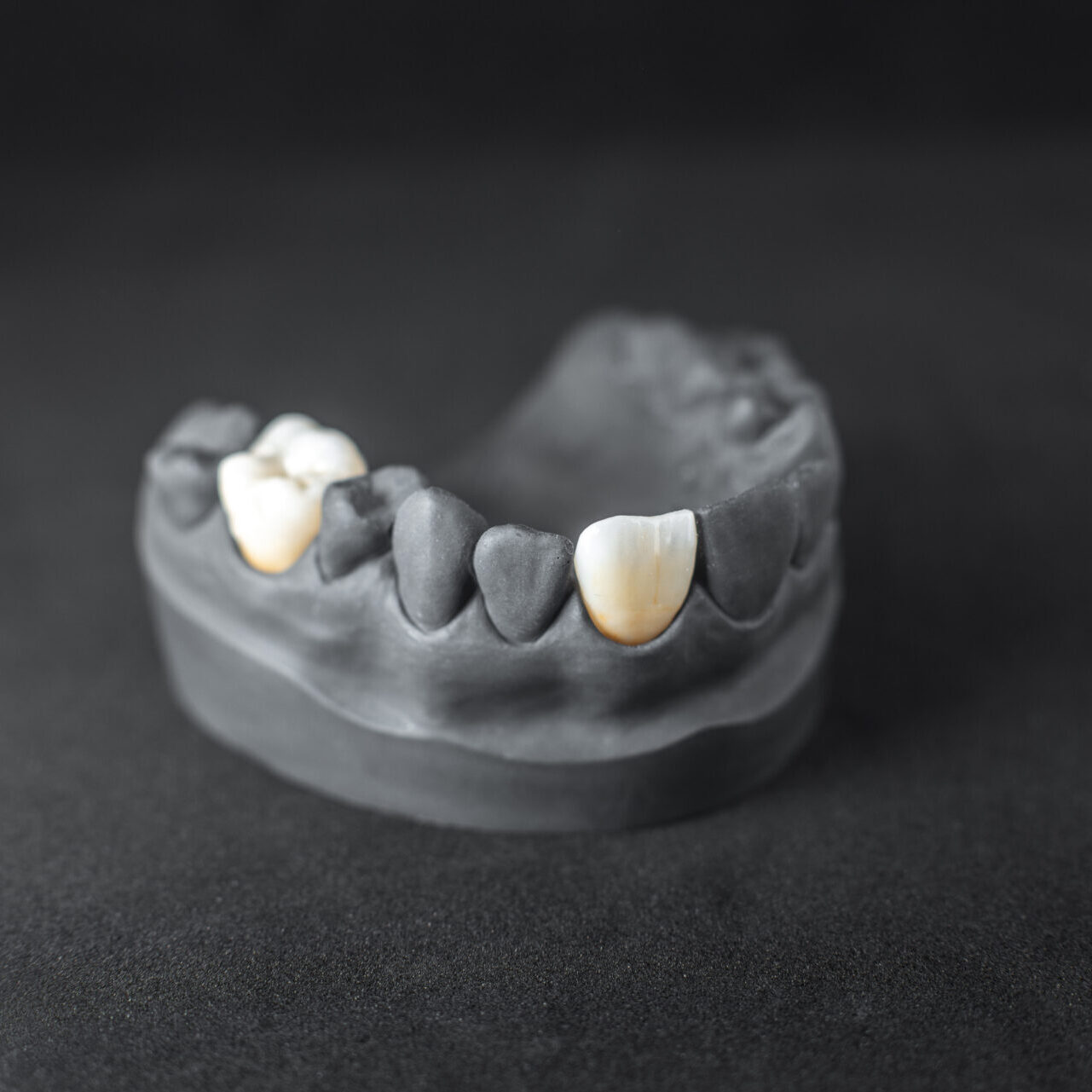 Close-up on plaster model of painted in black artificial jaw with implant crown on the black background. Concept of aesthetic dentistry and implantation