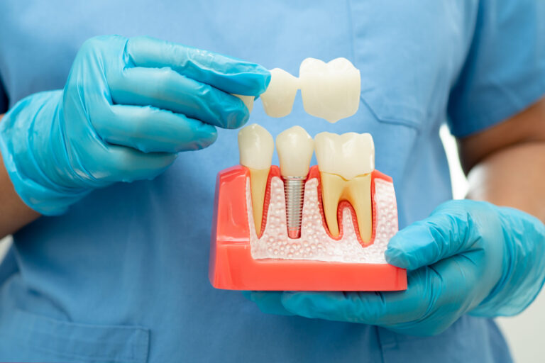 Dental Implant, Artificial Tooth Roots Into Jaw, Root Canal Of D Dental implant, artificial tooth roots into jaw, root canal of dental treatment, gum disease, teeth model for dentist studying about dentistry.