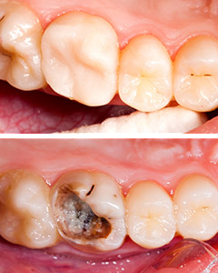 White Fillings