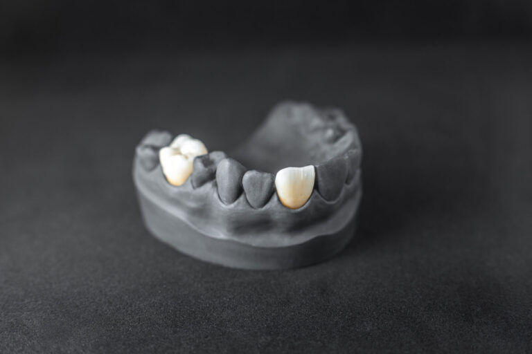Model Of Artificial Jaw With Dental Implant Close-up on plaster model of painted in black artificial jaw with implant crown on the black background. Concept of aesthetic dentistry and implantation