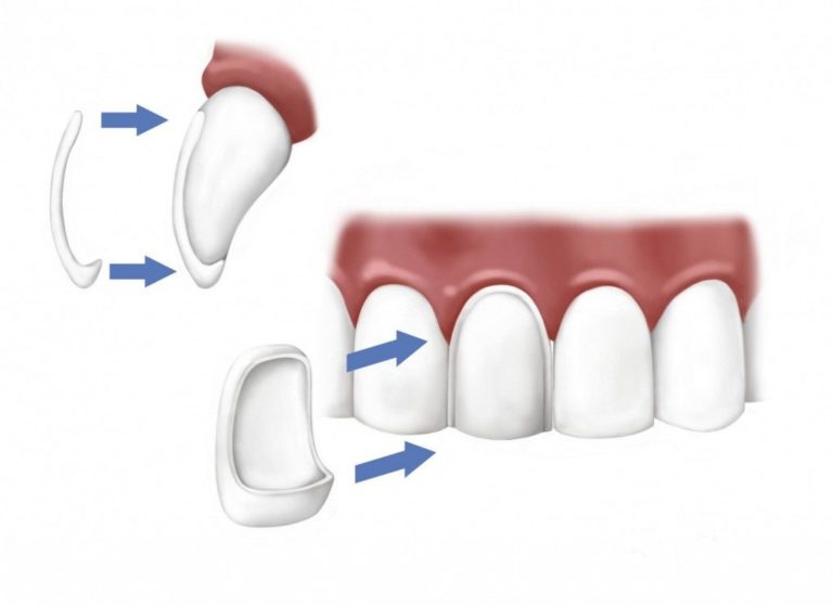 Dental Veneers Image