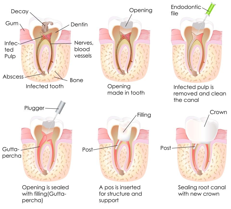 Endodontics: Root Canal Image